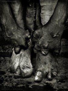 Man suffering from leprosy, Varanasi, India 2007